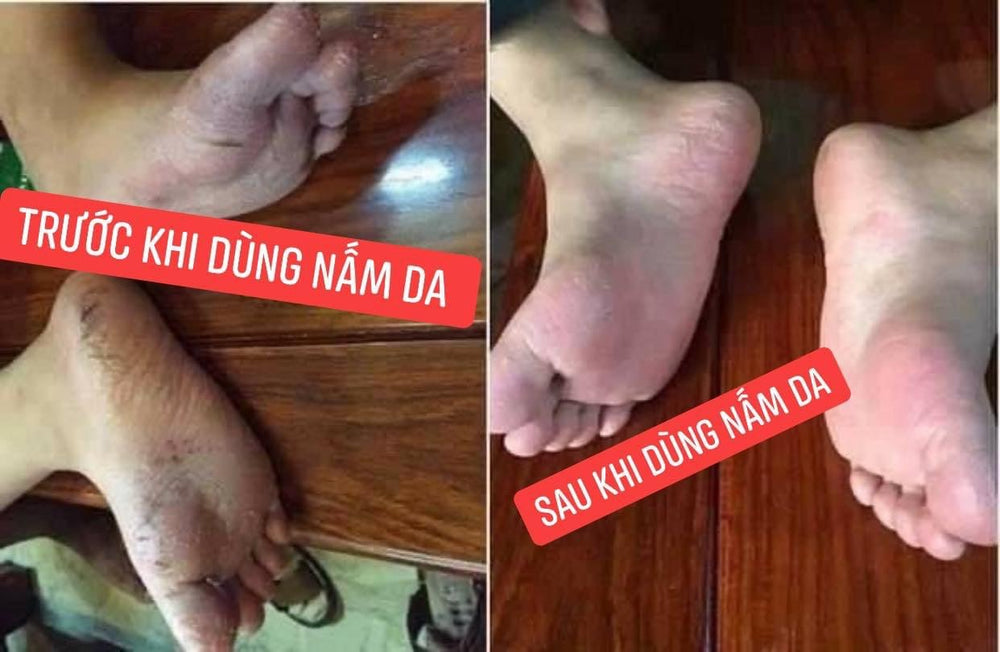 
                  
                    Thuoc Tri Nam Da - MEDI SKIN
                  
                