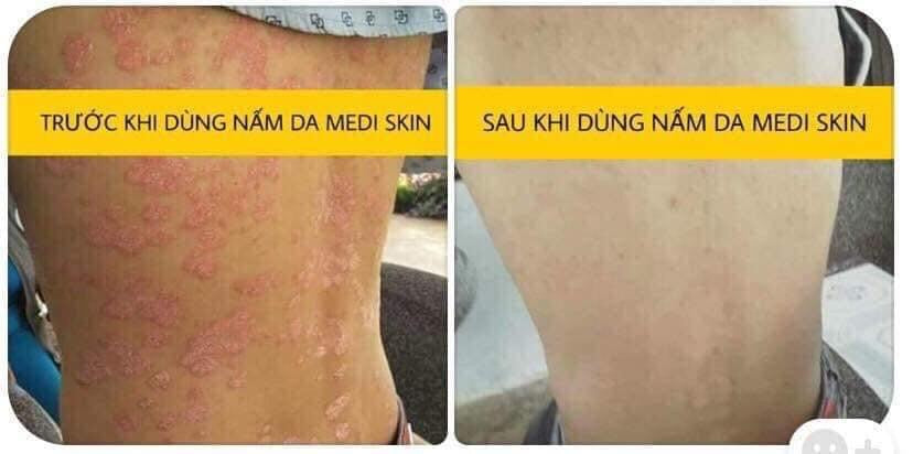 
                  
                    Thuoc Tri Nam Da - MEDI SKIN
                  
                